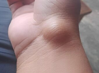 Αυτό το εξόγκωμα μπορεί να εμφανιστεί από κάτι που κάνετε κάθε μέρα