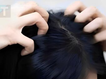 Κνησμός στο τριχωτό της κεφαλής; Αυτές είναι οι πιο συχνές αιτίες