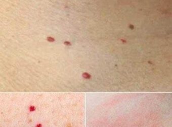 Αν δείτε αυτές τις κόκκινες κουκκίδες στο δέρμα σας είναι καλό να γνωρίζετε τι σημαίνουν
