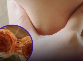 Επιζώντες λεμφώματος μοιράζονται έξι συμπτώματα που είχαν πριν από τη διάγνωση