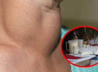 Όζοι θυρεοειδούς: Οι γιατροί συνιστούν να τρώμε λιγότερο από αυτή την τροφή