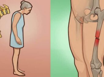 Οστεοπόρωση: Το ελληνικό βότανο που δυναμώνει και προστατεύει τα κόκκαλα