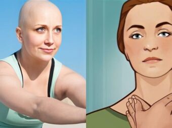 Λέμφωμα: Προσοχή στα συμπτώματα του πιο úπουλου καρκίνου