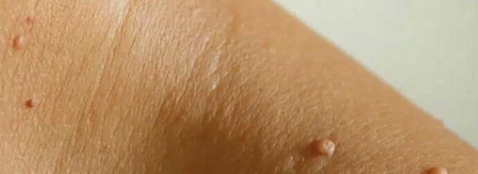 Γιατί εμφανίζονται σαρκώδεις ελιές στο λαιμό ή στις μασχάλες μου και πώς μπορώ να τις αφαιρέσω; Οι ειδικοί εξηγούν