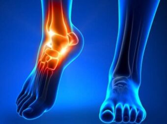 Ο χυμός που διαλύει το ουρικό οξύ στις αρθρώσεις