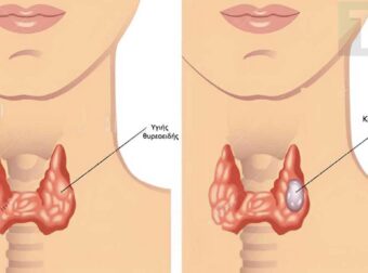 Οι περιπτώσεις καρκίνου του θυρεοειδούς αuξάνονται ραγδαία. Οι γιατροί σας συμβουλεύουν να τρώτε λιγότερο από αυτές τις τροφές