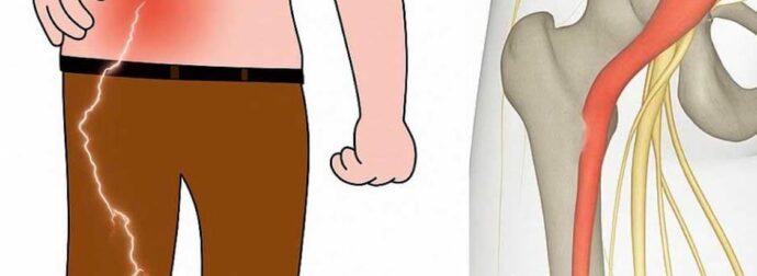 3 ασκήσεις για την ανακούφιση από τον ισχιαλγικό πόνο στο πόδι: πρακτικές και αποτελεσματικές