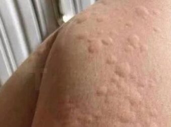 Γιατί εμφανίζονται πομφοί στο δέρμα; Αυτοί είναι οι απρόσμενοι παράγοντες που ίσως δεν γνωρίζετε