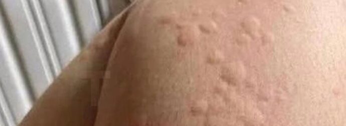 Γιατί εμφανίζονται πομφοί στο δέρμα; Αυτοί είναι οι απρόσμενοι παράγοντες που ίσως δεν γνωρίζετε