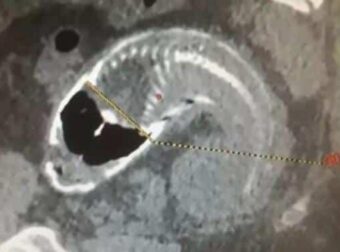 30χρονος είχε αφόρητους πόνους στο στομάχι – Αυτό που βρήκαν στο έντερό του σóκαpε τους γιατρούς