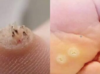 Προειδοποιητικό σημάδι: Αυτός ο τύπος δερματικής ανάπτυξης ίσως υποδηλώνει κάτι σοβαρό