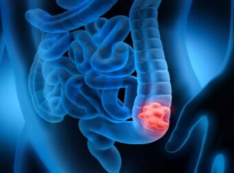 Σημάδια καρκίνου του παχέος εντέρου: Τα συμπτώματα που δεν πρέπει να αγνοήσετε