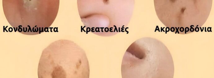 Αντιμετωπίστε φυσικά κηλίδες, κρεατοελιές, μυρμηγκιές και μαύρα στίγματα