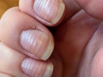Τι πραγματικά αποκαλύπτουν οι ραβδώσεις στα νύχια σας για την υγεία σας