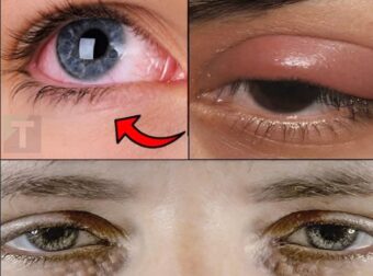 Αν έχετε κάποιο από αυτά τα σημάδια στα μάτια σας, συμβουλευτείτε αμέσως έναν γιατρό πριν να είναι πολύ αργά