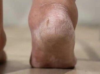 9 ορατά σημάδια στα πόδια που μπορεί να αποκαλύπτουν προβλήματα στο ήπαρ