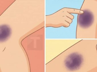 Mελανιές χωρίς ξεκάθαρη αιτία; Δείτε τι μπορεί να σας λέει το σώμα σας