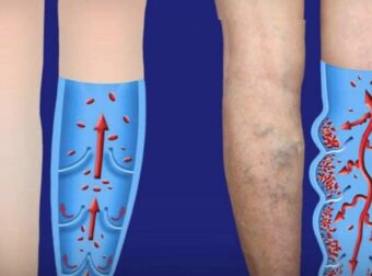 Κακή κυκλοφορία αίματος στα πόδια:  Δοκιμάστε αυτά τις 6 αποτελεσματικές συμβουλές