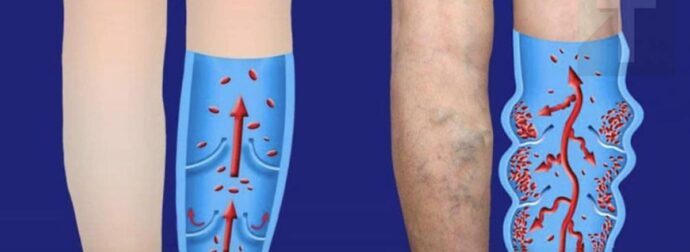 Κακή κυκλοφορία αίματος στα πόδια:  Δοκιμάστε αυτά τις 6 αποτελεσματικές συμβουλές