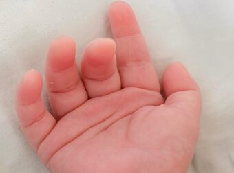 197 παιδιά γεννήθηκαν από δότη με καρκινικό γονίδιο – Χρησιμοποιήθηκε και στην Ελλάδα