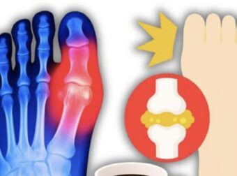 Το #1 ρόφημα για να αντιστρέψετε το υψηλό ουρικό οξύ και την ουρική αρθρίτιδα