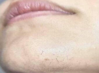 Αν είστε γυναίκα με γένια στο σαγόνι να τι σημαίνει για εσάς