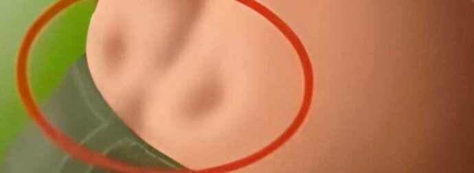 Έχετε δύο λακκάκια στο κάτω μέρος της πλάτης σας; Δείτε τι σημαίνει