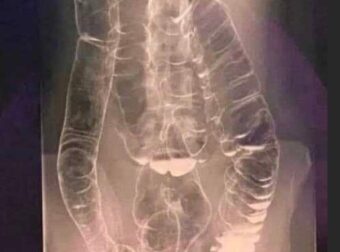 Χρόνια δυσκοιλιότητα – Μια σιωπηλή απειλή για την υγεία του πεπτικού συστήματος