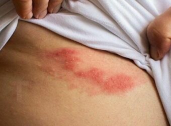 Όλα όσα πρέπει να γνωρίζετε για τα έρπητα ζωστήρα: Aιτίες, έγκαιρη ανίχνευση και φυσικές θεραπείες