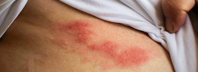 Όλα όσα πρέπει να γνωρίζετε για τα έρπητα ζωστήρα: Aιτίες, έγκαιρη ανίχνευση και φυσικές θεραπείες