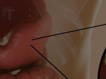 Πώς να απαλλαγείτε από το βακτήριο που ευθύνεται για την καούρα και το φούσκωμα