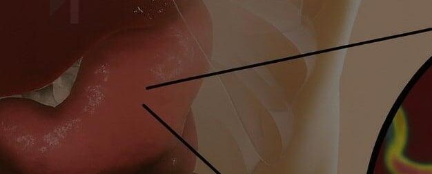 Πώς να απαλλαγείτε από το βακτήριο που ευθύνεται για την καούρα και το φούσκωμα