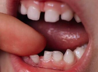 Να γιατί οι γονείς πρέπει να κρατούν τα νεογιλά δόντια του παιδιού τους. Μπορεί να σώσουν μια ζωή