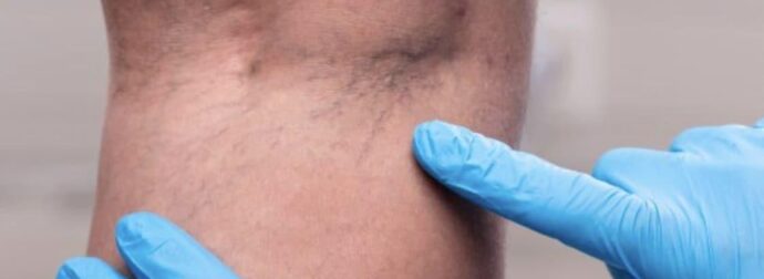 Tα χάπıα που δεν συνιστώνται γιατί μπορούν να φράξουν τις αρτηρίες και να προκαλέσουν θρόμβωση