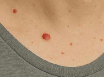 Γιατί εμφανίζονται κόκκινες ελιές στο δέρμα; Τι λέει η επιστήμη