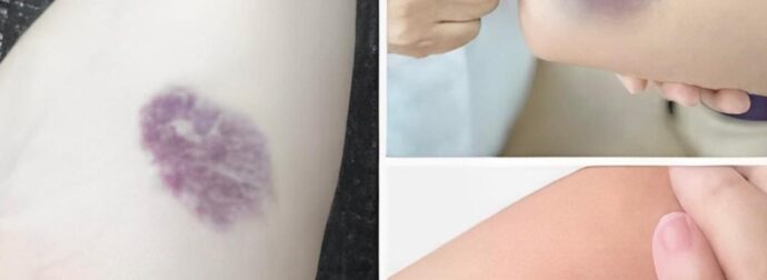 Αν εμφανιστούν τέτοιες μελανιές στο σώμα σας πρέπει να το κοιτάξετε