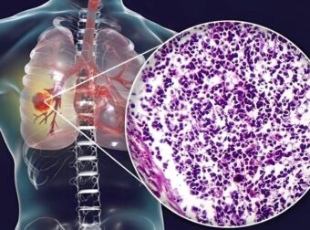 Ο αόρατος κίνδυνος – Τι κοινό υλικό κουζίνας συνδέεται με καρκίνο πνεύμονα – Προσοχή στο σπίτι σας