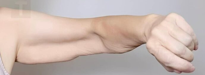 Σαρκοπενία: Αιτίες απώλειας μυϊκής μάζας και λύσεις