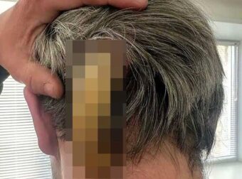 Άντρας ζούσε με τεpάστιο κέρατο στο κεφάλι του