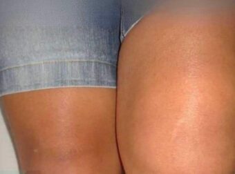 Γιατί το ένα γόνατο είναι πρησμένο αλλά όχι το άλλο;