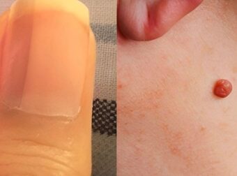 15 ύπουλα πρώιμα σημάδια του καρκίνου που οι περισσότερες γυναίκες αγνοούν