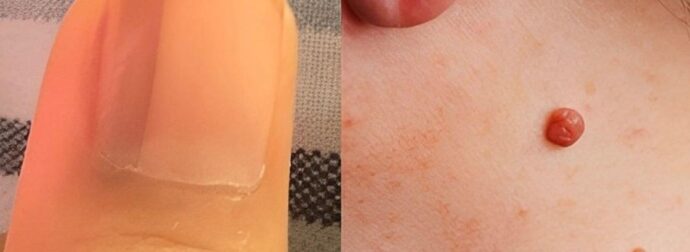 15 ύπουλα πρώιμα σημάδια του καρκίνου που οι περισσότερες γυναίκες αγνοούν