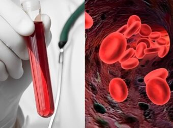 Αιματοκρίτης: Οι φυσιολογικές τıμές ανά ηλικία – Τι πρέπει να τρώτε για να τον αuξńσετε