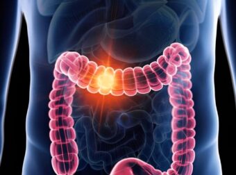 Πώς καθαρίσετε το έντερό σας; Θυμηθείτε αυτό το μυστικό των γιατρών