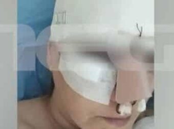 Εμπορικό Κέντρο Θεσσαλονίκης: «Σπασμένη μύτη, πλευρό, πάνω από 100 ράμματα από την κατάρρευση»