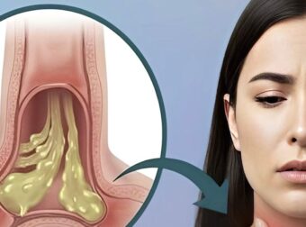 Πώς να ανακουφίσετε και να μειώσετε αποτελεσματικά και με ασφάλεια τα φλέγματα στον λαιμό