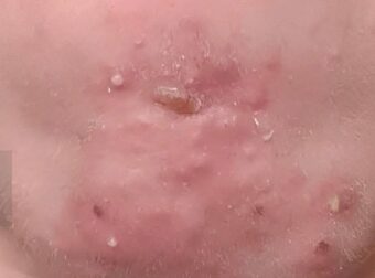 Έβγαινα με μια γυναίκα που γνώρισα στο σουπερμάρκετ και αφού τελικά πήγα μαζί της ξύπνησα με αυτά στο πρόσωπό μου. Τι είναι αυτό;