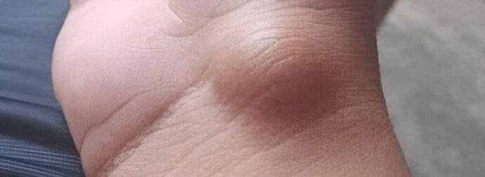 Αυτό το εξόγκωμα μπορεί να εμφανιστεί από κάτι που κάνετε κάθε μέρα