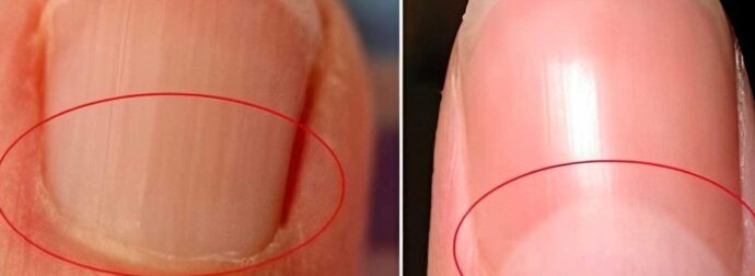 Τι πραγματικά είναι το ημισέληνο στη βάση των νυχιών σας;