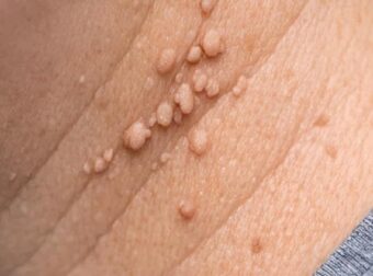 Αυτά τα μικρά δερματικά θηλώματα εμφανίζονται συνεχώς γύρω από τον λαιμό μου και δεν θα δω τον γιατρό μου για εβδομάδες. Τι μπορώ να κάνω άμεσα;